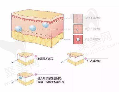 除皱纹的注射疗法