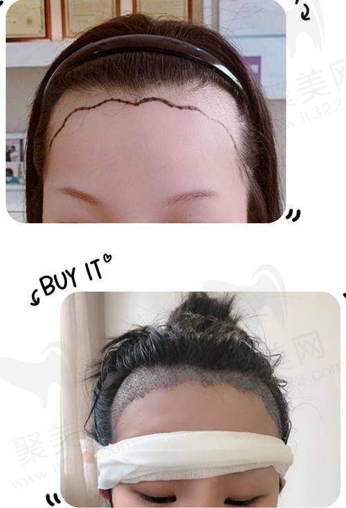 碧莲盛植发之价格明细特别清晰