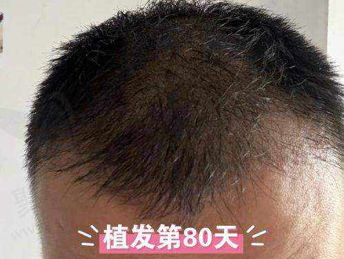 上海九院植发综合价格范围