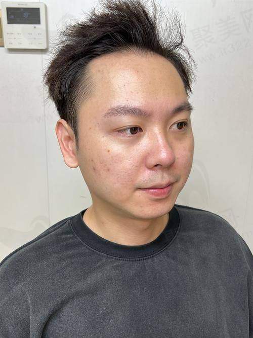 黄金微针修复期大概多久：总结
