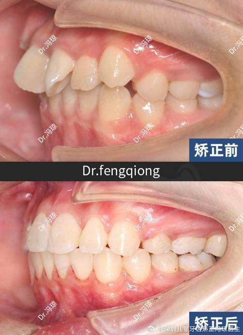 嘴凸怎么矫正？嘴凸矫正方法揭秘：牙性嘴凸、小孩嘴凸与成年矫正全解析，手术与非手术选择一网打尽！