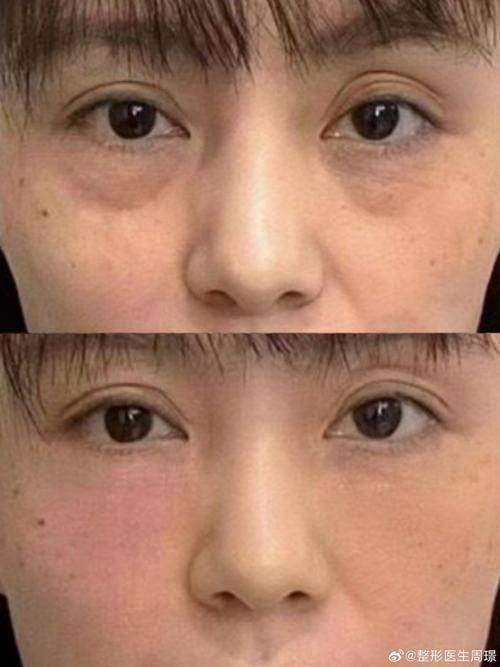 北京孙景波眼袋修复价格贵吗？