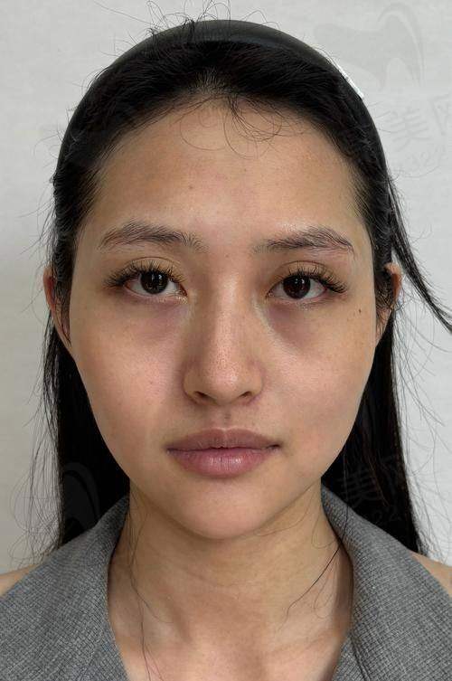 脸部不对称矫正多少钱？成年偏颌与脸部不对称矫正多少钱？有效方法与真实案例分享