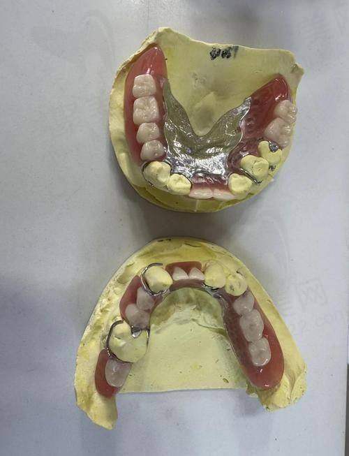 全口吸附性义齿的费用分析