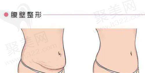 巨乳缩小术的原理及影响