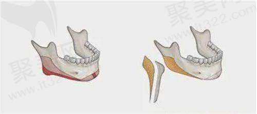胡凯医生特色技术优势