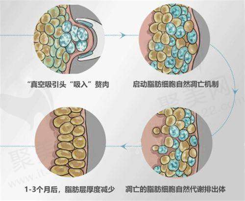 不同磨骨项目价格