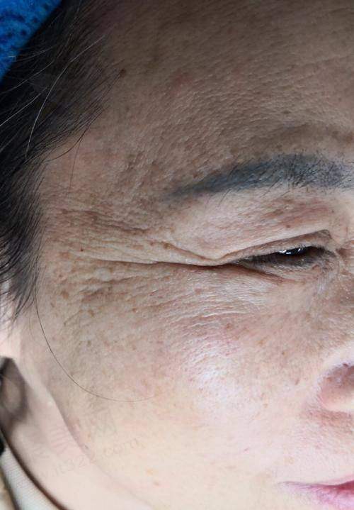 五、怎样淡化抬头纹：个性化方案选择