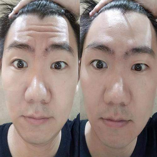 一、抬头纹形成的原因