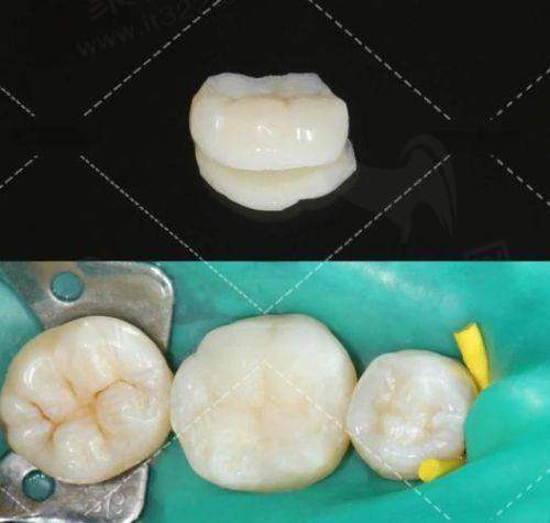 苏州美奥口腔医院铸瓷嵌体补牙1580元起，多优势技术与美观性强又耐用