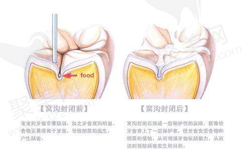 苏州美奥口腔医院儿童窝沟封闭技术优势显著