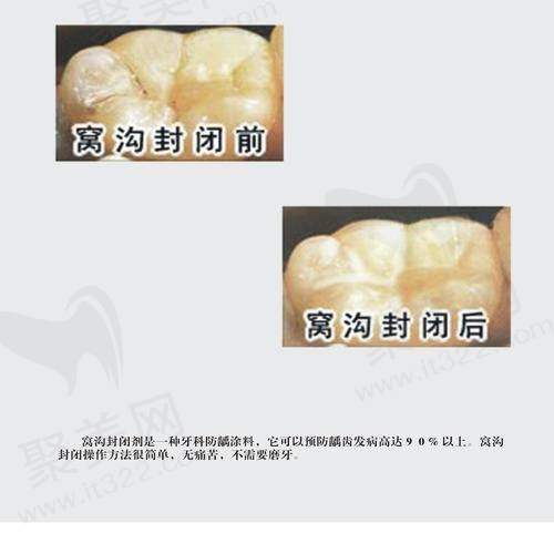 苏州美奥口腔医院儿童窝沟封闭服务贴心周到