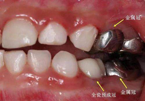 冠套修复是什么，实际实例分析