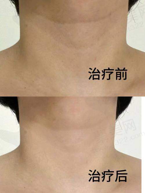 嗨体的副作用和危害之局部组织损伤