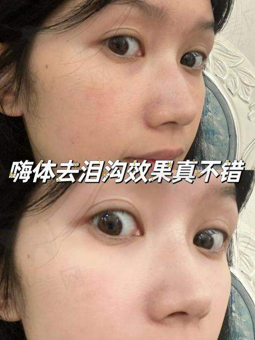嗨体的副作用和危害之过敏反应