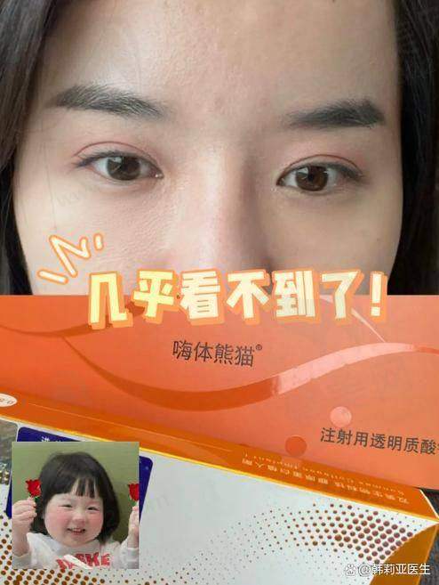 嗨体的副作用和危害之皮肤凹凸不平