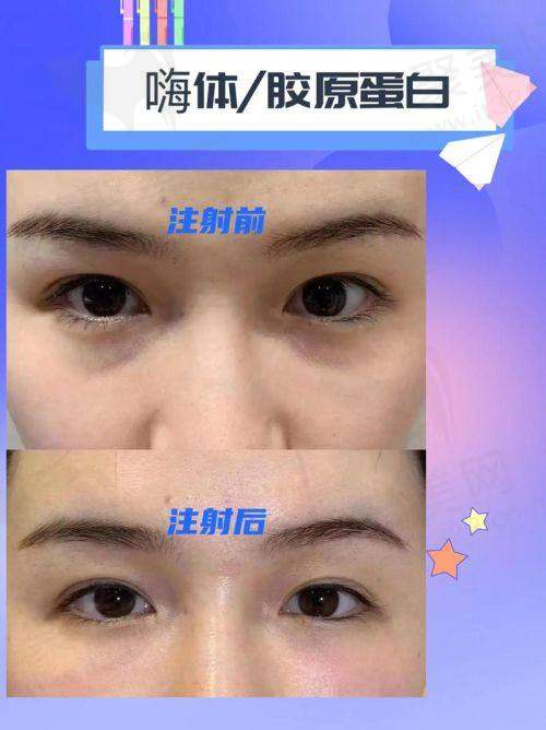 嗨体的副作用和危害之组织栓塞