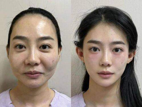 蹇洪苹果肌复位成效：自然又持久