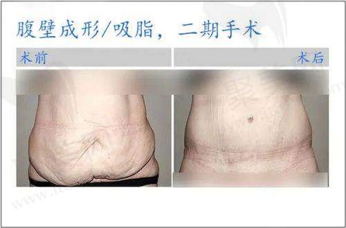 东莞美立方张克修复双眼皮的技术特色
