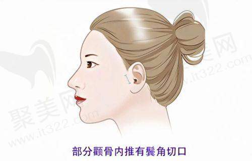 东莞美立方张克修复双眼皮的口碑评价