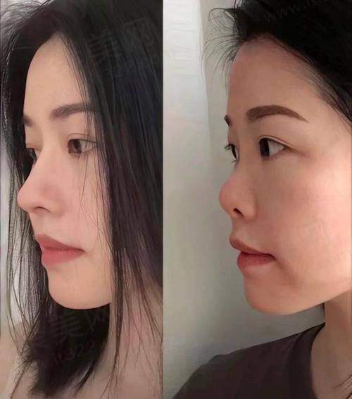三、杨季涛医生做鼻子的优势