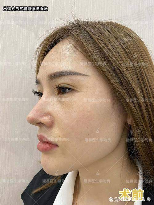 三、深圳张辉赫本鼻价格体系