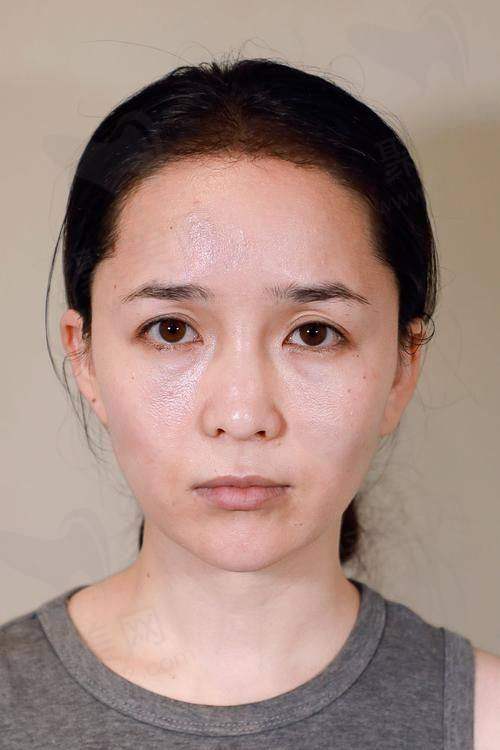 一、玻尿酸的基本认知