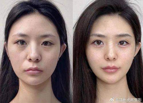 二、玻尿酸的神奇功效