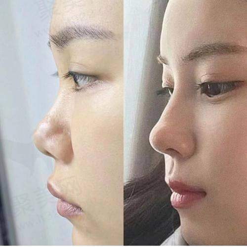 濡白天使隆鼻可以维持多久：影响因素之个人体质