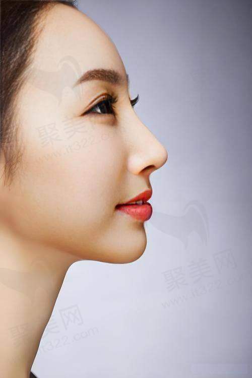 濡白天使隆鼻可以维持多久：影响因素之注射剂量