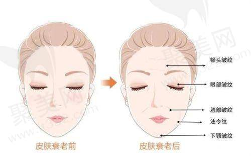 伊妍仕少女针的副作用
