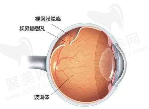 北京何氏眼科医院白内障手术收费标准如何？