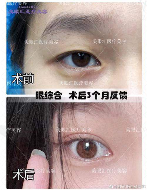 二、徐学东医生做眼睛的技术优势