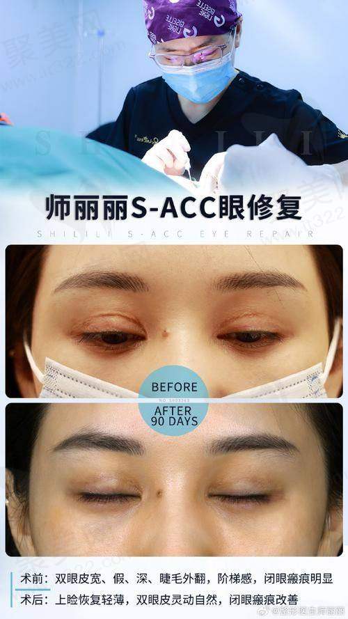上海马娟双眼皮修复怎么样？双眼皮修复真实实例分享，在业界的良好口碑不是空穴来风
