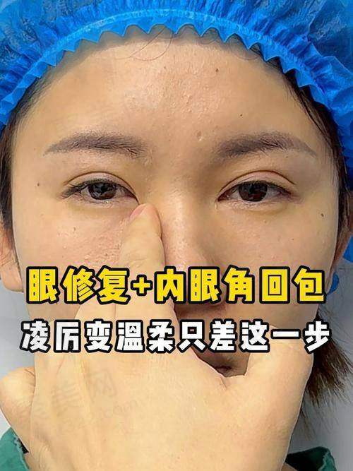 上海马娟双眼皮修复怎么样——个性化定制