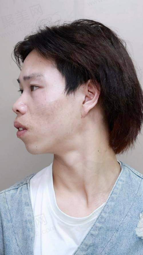 五、王涛医生正颌手术的真实实例