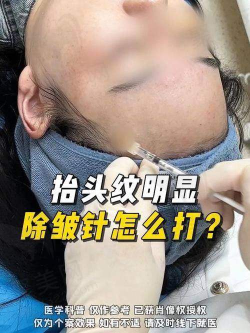 三、不同类型抬头纹的治疗方法