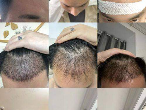 二、成都大麦和雍禾哪个好点——植发技术对比