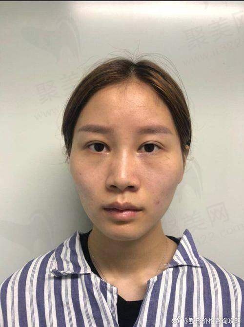 二、磨骨技术特点与原理