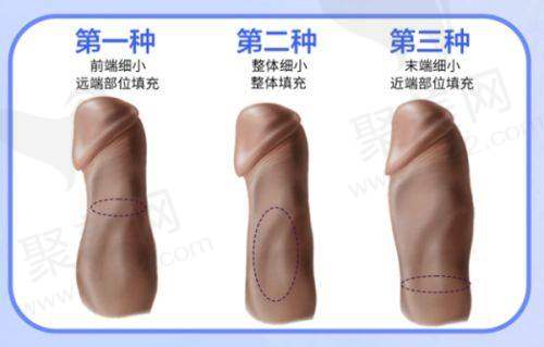 三、东莞植发费用情况