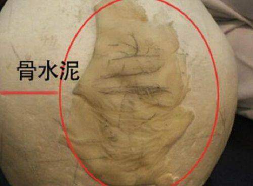 一、重庆华美吸脂医院详细介绍