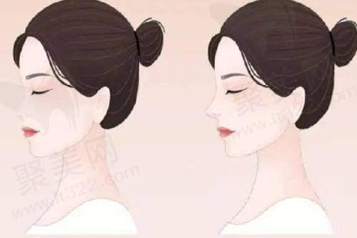 深圳超皮秒激光祛斑哪家好？深圳美莱、深圳富华、深圳阳光这几家值得考虑！