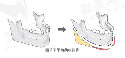 韩国id整形医院