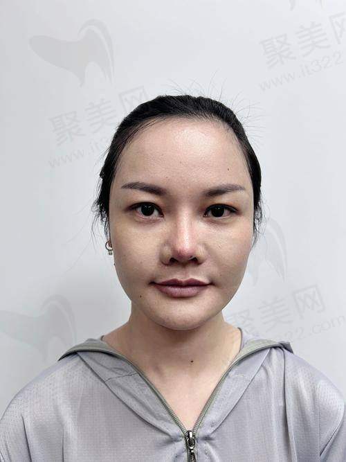 三、医美手段有效消除法令纹的方法