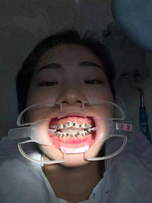 标准的牙齿咬合图片的定义