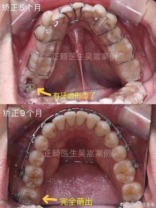 预防牙齿咬合问题的策略