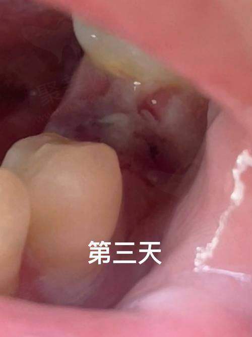 后悔拔掉烂牙根？揭示烂牙根处理方式与修复方案的真相！