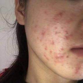 深圳阳光整形医院红蓝光＋清痘针的作用与成效如何？