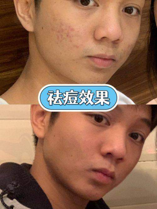 深圳阳光整形医院红蓝光全面部＋清痘针原价2431元现399元起，刺激性小效果好