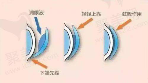温州明乐眼科医院屈光技术总监沈政伟有何专长？